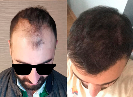 Transplante capilar - foto antes-depois 1