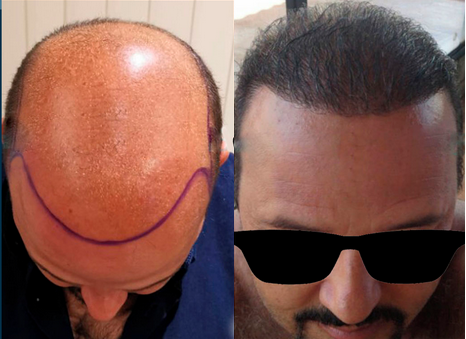 Transplante capilar - foto antes-depois 2