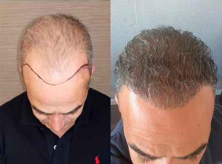 Transplante capilar - foto antes-depois 3