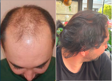 Transplante capilar - foto antes-depois 4